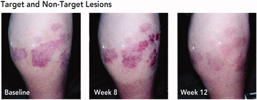 Figure 3. Posttreatment gain of treatment success with HP/TAZ lotion. Treatment success was defined as ≥2-grade improvement from baseline IGA and a score of 0 (clear) or 1 (almost clear). Representative images from a participant with target and non-target lesions on the lower leg. aLesions indicated by white stickers on participant’s leg; target lesion indicated by sticker with letter ‘T’. Participant IGA: baseline, 3; week 8, 2; week 12, 0. Participant BSA: baseline, 6%; week 8, 4%; week 12, 0%. BSA: body surface area; HP/TAZ: halobetasol propionate 0.01% and tazarotene 0.045%; IGA: Investigator’s Global Assessment.