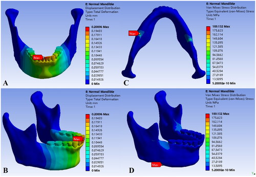 Figure 6. Displacement distribution (A and B) and Von Mises stress distribution (C and D) of the normal mandible.