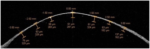 Figure 2 Another anterior segment optical coherence tomography image demonstrating the thinness and smoothness of the graft after a double-pass technique.