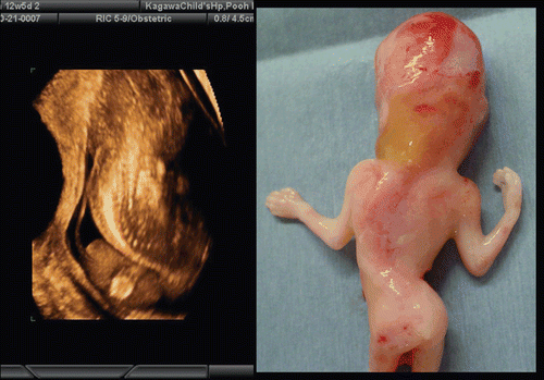 Figure 27.  Severe scoliosis at 12 weeks of gestation. Left; 3D image of fetal back. Severe scoliosis is demonstrated. Right; Back view of aborted fetus. Fetal karyotype was normal.