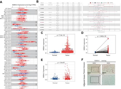 Figure 1 KRBA1 expression levels in LIHC and Other Cancers. (A) The mRNA expression levels of KRBA1 in pan-cancers based on the TIMER database. (B) The mRNA expression levels of KRBA1 in HCC and normal tissues based on the HCCDB database. (C) The mRNA expression levels of KRBA1 in 374 tumor cases and 50 normal tissues cases based on TCGA database. (D) The mRNA expression levels of KRBA1 in 50 pairs of matched tumor and normal tissue cases based on TCGA database. (E) The mRNA expression levels of KRBA1 based on ICGC database. (F) Typical images of IHC in 40 pairs of HCC tissues showing the protein expression of KRBA1 in HCC and adjacent tissues.