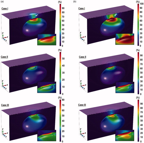 Figure 8. Contours of PD across the tumor, the bladder and the surrounding tissue across the z = 0 plane, the skin surface (for z < 0) and the inner wall of the bladder after 10 min of 0.2 W laser irradiation. (a) ϕ = 0.005% and (b) ϕ = 0.01%. Inset: enlarged view of the tumor and the tissue above it.