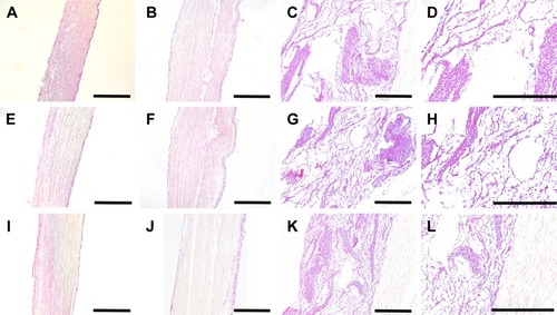 Figure 7 HE-stained histology images show BMSCs’ distribution on different scaffolds up to 14 days.Notes: AFS (A, E, and I), AYS (B, F, and J), and HS (C, D, G, H, K, L) at days 3 (A–D), 7 (E–H), and 14 (I–L), respectively. Panels (D, H, and L) were local amplification images of (C, G, and K). Scale bars: 200 μm for all images.Abbreviations: AFS, aligned nanofiber scaffolds; AYS, aligned nanoyarn scaffolds; BMSCs, bone marrow-derived mesenchymal stem cells; HE, hematoxylin and eosin; HS, hybrid scaffold.