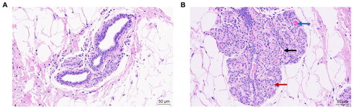 Figure 2. H&E staining of breast tissues before and after modeling. (A) Before modeling (B) After modeling. The blue arrow shows secretions, the black arrow shows dilated lumen, and the red arrow shows increased number of glandular follicle cells.