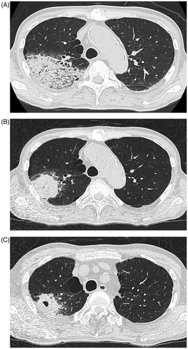 Figure 2. (A) Chest CT; at the onset of severe pneumonitis caused by Pseudomonas aeruginosa. (B) Chest CT; inflammatory cavitary lesion was remained in right upper lobe after sepsis treatment. (C) Chest CT; obvious cavitary lung lesion in the right upper lobe.