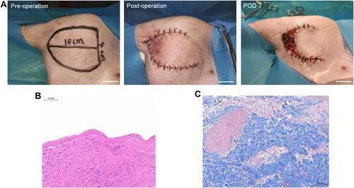 Figure 5 Clinical potential of NIR-II fluorescence imaging in early prediction of tissue necrosis of skin avulsion-injuries. (A) Digital images of preoperation (left), postoperation (middle), and on POD7 (right) of avulsed flap of porcine hindlimb. (B) H&E staining of “dark area” skin of avulsed hindlimb flap on POD7. (C) Masson’s trichrome staining of “dark area” skin of avulsed hindlimb flap on POD7. Bars 3 cm (A), 0.1 mm (B,C).