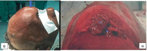 Figure 3 Photos of the patient perioperatively on operating table at supine position demonstrating frontal mass (G and H), the mucocele is well visualized with extension to the subcutaneous tissue.