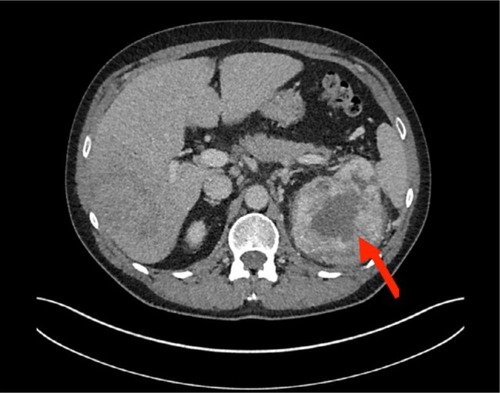 Figure 1 Abdomen–pelvis CT scan showing left renal mass encroaching the left renal vein.