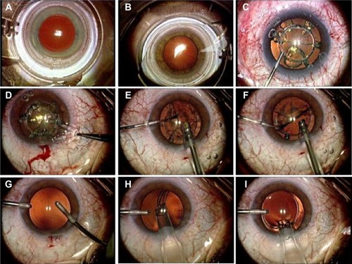 Figure 1 Femtosecond laser-assisted cataract surgery with the LDV Z8 system.
