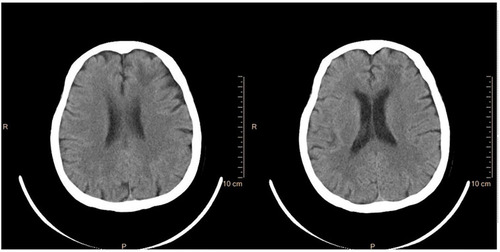 Figure 7 Brain CT (13rd Oct 2020): the lesion almost disappeared in the left frontal lobe.
