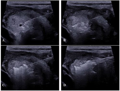 Figure 4. ‘pTA-UsNodule’: post-Thermal-Ablation Ultrasound Nodule. The electrode is introduced slowly in the nodule (A) after a peri-capsular anesthesia with lidocaine. The electrode is located one centimeter before the limits of the nodule (to avoid carotid and vagal nerve contact = ‘danger zone’) (B). The micro bubbles correspond to gas due to carbonization of the tissue (hyper-echoic aspect) (C). The electrode was slowly removed until the anterior limit (see bubbles around the nodule) (D).