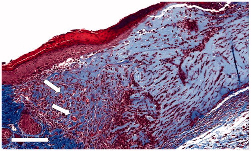 Figure 6. Micrograph of Trichrome-stained Capgel™-treated full-thickness dermal wound, d7. Capgel™ presented in varying degrees of resorption moving from the lateral wound edge (left) to the center (right); injected Capgel™ material towards the lateral edge was more resorbed and contained numerous microvessels by d7 (arrows). Scale bar: 150 µm.