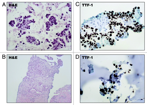 Figure 2. Histopathologic features of the EML4-ALK translocation positive tumor from patient 1. (A) An FNA of the patients left lung tumor showed malignant cells with hematoxylin and eosin (H&E) staining. (B) A core needle biopsy of the primary left lower lobe lung tumor showed moderately-differentiated adenocarcinoma. (C) The tumor cells exhibited nuclear expression of TTF-1 by IHC. (D) A biopsy of a nasal bone lesion confirmed metastatic disease which similarly expressed TTF-1 by IHC.