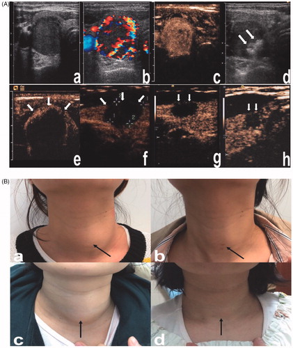 Figure 6. Images and appearance of the neck. A. Images of RFA treatment and follow-up of a thyroid nodule. (a) Conventional ultrasound image showed a solid thyroid nodule. (b) Color Doppler ultrasonography image showed abundant vascularity. (c) CEUS performed before RFA showed homogeneous hyperenhancement in the nodule (white arrows). (d) After a multisite injection of small amounts of ethanol (white arrows indicate echo-staining), RFA was performed using the moving shot technique. (e) CEUS was performed immediately after RFA and showed a complete lack of enhancement in the treated area (white arrows). (f) One month after RFA, the nodule volume (white arrows) was significantly reduced by 49.5%. (g) Three months after RFA, the nodule volume (white arrows) was significantly reduced by 76.3%. (h) Six months after RFA, the nodule volume (white arrows) was significantly reduced by 85.7%. The lesion margin is indicated by ‘+’. RFA, radiofrequency ablation; CEUS, contrast-enhanced ultrasound. B. Comparisons of the appearance of the neck before and after ablation. (a, b) A 27-year-old patient. Before RFA, a quail egg-sized nodule could be seen under the skin of the neck (black arrow), and tenderness could be felt. Three months after RFA, the thyroid nodule markedly shrunk, and no scars were left on the neck (black arrow). (c, d) A 33-year-old patient. A quail egg-sized nodule was visible under the skin of the neck (black arrow) prior to EA combined with RFA. Three months after RFA, the nodule almost disappeared, and no scars were left on the neck (black arrow).