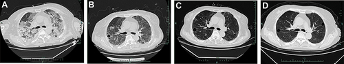 Figure 3 Chest CT images of the patient. (A) Chest CT on January 10, 2022. (B) Chest CT on January 17, 2022. (C) Chest CT on February 6, 2022. (D) Chest CT on April 16, 2022.