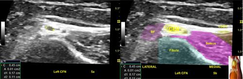 Figure 5 (A) Shows a normal common fibular nerve (CFN) at fibular head of Figure 3 with normal fascicles, the most prominent fascicle at the upper limit of normal (1 mm2) in cross-sectional area. The color shading in (B) with labeling are for illustration purpose. Image is courtesy of 3D4Medical’s Essential Anatomy 5 appAbbreviations: BF, biceps femoris; Gastroc, gastrocnemius; LSCN, lateral sural cutaneous nerve.