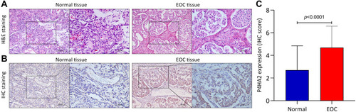 Figure 1 The up-regulation of P4HA2 in clinical samples of patients with EOC. (A) The normal ovarian tissues and EOC tissue were pathologically confirmed using H&E staining. Representative images were shown at 200× magnification (scale bar, 100 μm) and 400× magnification (scale bar, 50 μm). (B) The expression of P4HA2 in normal ovarian tissues and EOC tissue were detected using IHC staining. Representative images were shown at 200× magnification (scale bar, 100 μm) and 400× magnification (scale bar, 50 μm). (C) Semi-quantitative P4HA2 expression in normal ovarian tissues and EOC tissue by staining score.