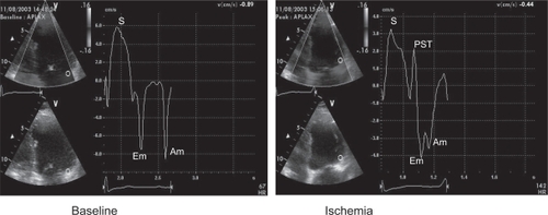 Figure 3 Typical regional velocity response to ischemia seen with tissue doppler imaging. In this example the basal lateral wall velocities are analyzed. At peak stress the systolic(s) and diastolic (Em and Am) are reduced. There is also a delayed contraction seen after aortic valve closure (PST).