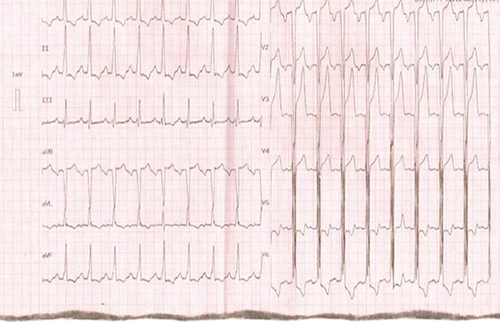 Figure 1 Electrocardiography: shows left ventricular hypertrophy and left bundle branch block.