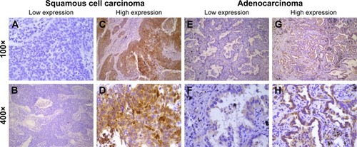 Figure 2 Immunohistochemical staining of CIP2A in squamous cell carcinoma and adenocarcinoma.