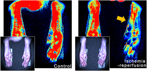 Figure 2 Compare of blood perfusion of the ischemic limb and contralateral nonischemic limb after IRI modeling. Determined and photographed with a laser image-speckle interferometer. The yellow arrow indicates the poor perfusion.