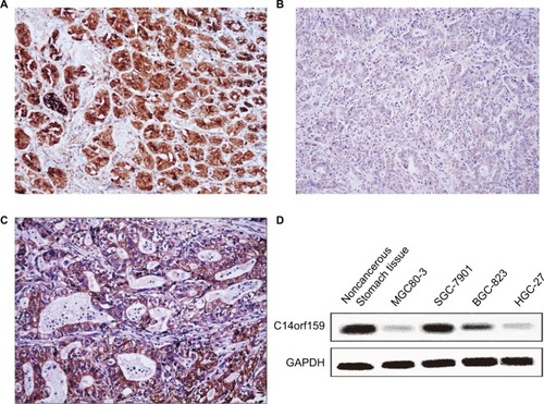 Figure 1 The expression of C14orf159 in both gastric cancer specimens and cell lines.Notes: C14orf159 revealed strong cytosolic expression in noncancerous stomach tissues (A, 200×); however, it showed dim expression in the cytoplasm of gastric carcinoma specimens (B, 200×). In some gastric cancer tissues, it was positively expressed (C, 200×). (D) C14orf159 was expressed in noncancerous stomach tissue and all four gastric cancer cells (MGC80-3, SGC-7901, BGC-823 and HGC-27), highly expressed in 7901 cells and less expressed in 803 cells. Data are mean ± SEM from three independent experiments.Abbreviation: SEM, standard error of the mean.