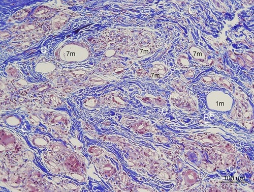 Figure 12 In Masson’s Trichrome stain, collagen stained blue (100× magnification). Thick irregularly arranged and blue-stained collagen bundles (C) deposited around CaHA particles (7 m) injected 7 months pre-biopsy, while finer, thinner, and more indistinct blue collagen fibers were assumed to be pre existingd collagen around 40-micron (recently injected) particles (1 m). Abundant FGCs (stained light brwon) and its nuclei (dark brwon dots) observed around smaller CaHA particles. (Pre existing collagen fibers: “Pc”, Reinforced mature collagen: “C”).