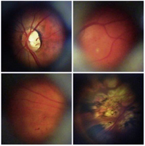 Figure 2 Representative retinal images of no apparent diabetic retinopathy (top left), mild nonproliferative diabetic retinopathy (top right), moderate nonproliferative diabetic retinopathy (bottom left), and panretinal photocoagulation scars in proliferative diabetic retinopathy (bottom right).