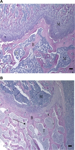 Figure 1 Hematoxylin and eosin (H&E) stains of ipsilateral distal femur. Histological sections of the ipsilateral femoral epiphysis from vehicle (A) and MLL (MATLyLu) cell injected (B) rats. Visible in the figure is eroded trabecular bone (arrow). Sections were stained with H&E. M, marrow, B, bone, T, tumor. Bar represents 100 μm.