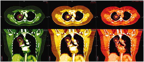 Figure 2. Example of lung cancer patient chosen for dose comparison. The pCT is at the left (green), the merged CBCT at the right (red), and the 6 D fusion between the two is shown in the middle. Tissue being identical on both scans appears in white, yellow, brown colors (depending on tissue density). Deviations appear in red or green. Gross tumor volume for tumor and one lymph node is shown as a red line and the clinical target volumes are shown as a pink line.