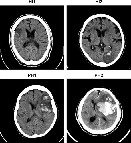 Figure 1 Subtype of hemorrhagic transformation HI1 (top left), HI2 (top right), PH1: (bottom left), PH2: (bottom right).