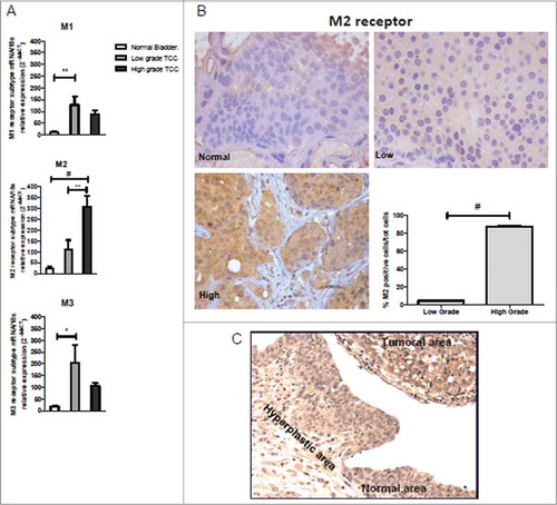Figure 1. Muscarinic receptor expression in bladder cancer biopsies. (A) M1, M2 and M3 mRNA expression levels in normal bladder and in low and high TCC grade. mRNA levels for M1 and M3 receptor subtype were significantly upregulated only in low-grade tumor tissues compared to controls, differently from mRNA levels for M2 subtype receptor whose expression in the high-grade tumors was statistically significant increased than both in normal tissue and low-grade tumors (B) Immunohistochemistry analysis for M2 receptor expression. M2 expression in normal, low, and high TCC grade (40×). The graph shows the quantification of the percentage of the M2 positive cells in high and low TCC grade. (C) Immunohistochemistry analysis showing the M2 receptor expression in the normal and transitional area nearby the tumoral region. Magnification 20×. *P < 0.05, **P < 0.01, #P < 0.001.