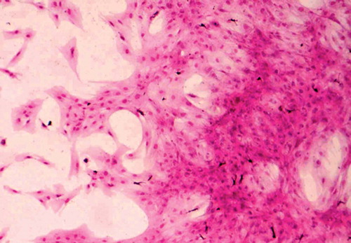 Figure 1. Photomicrograph of fibroblast colony-forming units obtained from cultured iliac bone marrow mononuclear cells (Wright's stain, magnification × 160).