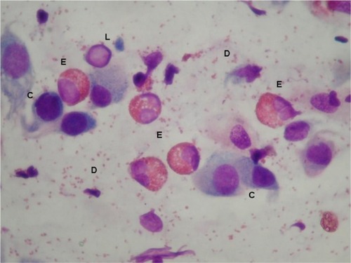Figure 2 Nasal cytology shows eosinophils (E) with abundant degranulation (D), lymphocytes (L), and epithelial cells (C), stained by the May-Grunwald-Giemsa method with a magnification of ×1,000.