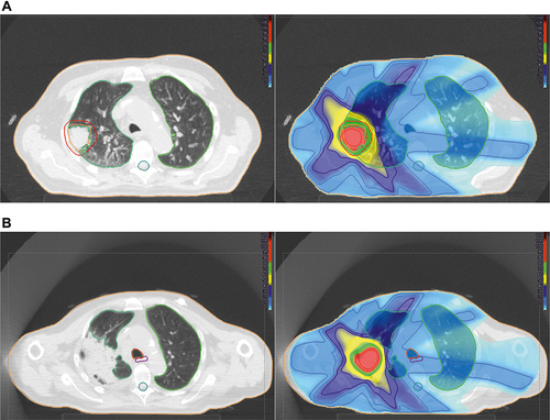 Figure 3 Radiation pneumonitis after SBRT. (A left): 80-year-old patient with histologically proven non-small cell lung carcinoma (within the red contour). Planning target volume (red contour) and organs at risk: Total lung (green), spinal cord (turquoise). (A right): Treatment plan (IMRT-technology, 9 Gy in 5 fractions, total dose 45.0 Gy): Isodose lines (% of total dose) and the dose distribution, high-dose region surrounding the tumour (red, green), step down gradient (yellow, dark blue). The low-dose region is highlighted in blue. Using IMRT, the lung volume receiving low doses is less compared to VMAT (B left): Consolidative changes after SBRT, suspect of tumour progression, but radiation pneumonitis was retrospectively diagnosed. (B right): A deformable image registration was used to correlate the lung changes on follow-up CT-scan with radiation dose distribution. The changes are highly conformal to the high-dose region.