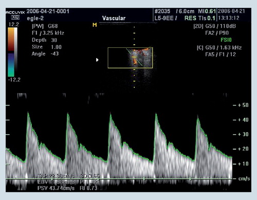Figure 1. Color Doppler imaging measures velocity in retrobulbar blood vessels.Outcome parameters include peak systolic (PSV) and end diastolic (EDV) blood flow velocities, and also calculated vascular resistance index, which is equal to (PSV-EDV)/PSV.Color figure can be found online at www.expert-reviews.com/doi/full/10.1586/eop.12.41