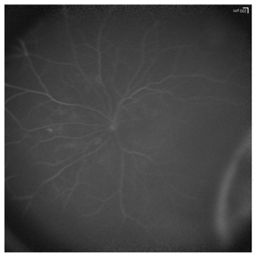 Figure 3 Ultrawidefield angiography of the left eye demonstrates irregularly staining hyperfluorescent lesion anterior to the equator in the temporal region.