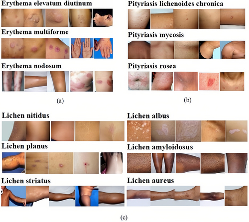 Figure 3 Fine-grained classified images. Collected subspecies in erythema (a), lichen (b), and pityriasis (c) as examples. Images in such subspecies have tiny interclass variance and significant intraclass variance, causing challenges in correctly diagnosing similar dermatological diseases.