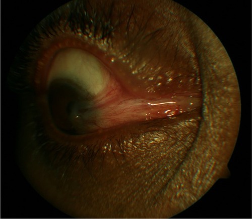 Figure 1 Multirecurrent pterygium (five previous excisions) with symblepharon before treatment.