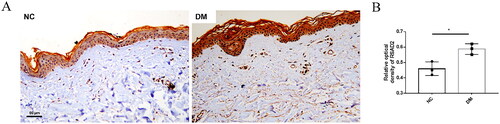 Figure 7. RSAD2 is elevated in skin fibroblasts of patients with DM. (A:Representative immunohistological staining of RSAD2 in the skin of DM and NC patients. B. Statistical analysis of RSAD2 immunohistochemistry. DM, dermatomyositis, n = 3; NC, normal control, n = 3. Scale bar = 50 μm.).