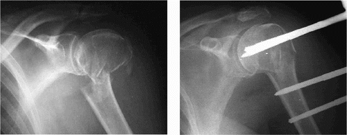 Figure 1. A 2-part fracture preoperatively and after 5 weeks.