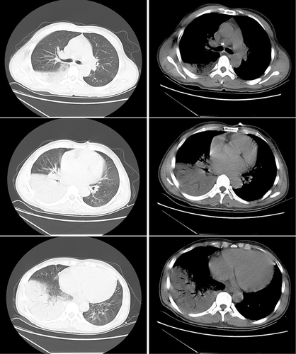 Figure 1 CT image of the chest before the treatment of pneumonia caused by Chlamydia abortus.