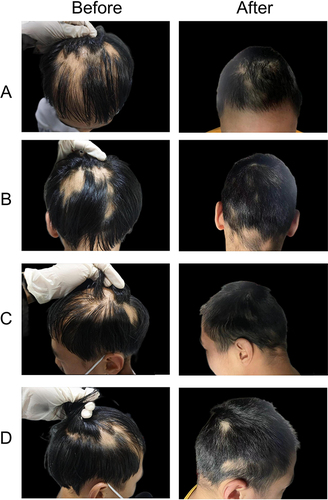 Figure 3 Photographs of a representative patient in the tofacitinib group: panel A-D showed different regions of scalp before and after treatment ((A) top, (B) posterior, (C) left side, (D) right side).