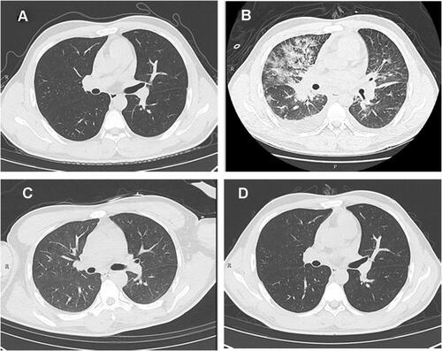 Figure 1 Chest CT images of the acute tonsillitis patient after admission. (A) Chest CT image on March 19th, 2020, the admission day 1; (B) chest CT image on March 21st, 2020, the admission day 3; (C) chest CT image on March 27th, 2020, the admission day 8; (D) chest CT image on April 2nd, 2020, after discharge.