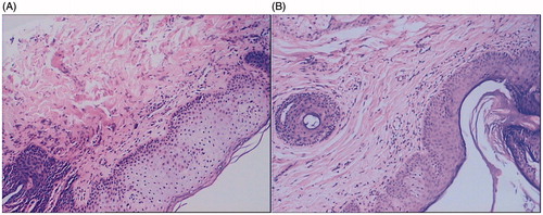 Figure 1. Pathological features of SH before and after HIFU treatment. (A) SH before treatment, squamous epithelial cell proliferation, extended epithelial ridges, excessive cornification in epidermis, thickened prickle cell layers, and various degrees of lymphocytes infiltration. (B) SH after treatment, the cornification of epithelial cells and the structure of the prickle cell layer are normalised. HE (hematoxylin-eosin staining) 100 × diseased tissues.
