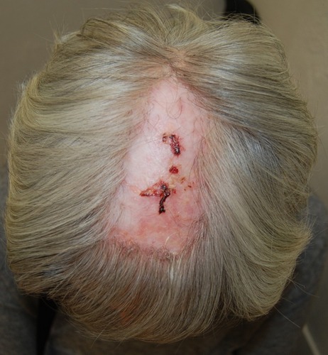 Figure 1 Typical clinical aspect of EPDS with superficial erosions and crusted lesions on atrophic skin.