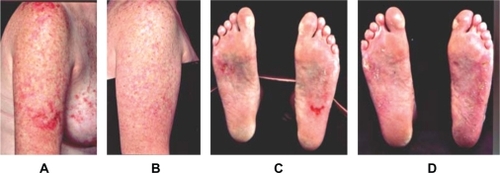 Figure 1 Two patients with SCLE lesions on upper right limb and SCLE lesions on soles, respectively, before (A, C) and after (B, D) treatment with tacrolimus ointment. Copyright © 2004. Reprinted with permission from Lampropoulos CE, Sangle S, Harrison P, Hughes GR, D’Cruz DP. Topical tacrolimus therapy of resistant cutaneous lesions in lupus erythematosus: A possible alternative. Rheumatology (Oxford). 2004;43:1383–1385.