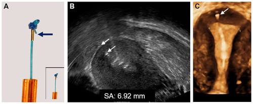 Figure 3 (A) Anchor with visualization element (magnification x 2.5): Tiny metal piece (2 mm long and 0.5 mm in diameter; insert: real size); (B) 2–D ultrasound of visualized anchor located 6.92 mm from the serosa of the uterus (arrows); (C) 3–D ultrasound showing the frameless IUD respecting the anatomical configuration of the small uterine cavity. The anchoring knot is placed in the fundal tissue (arrow) assuring proper retention of the IUD.