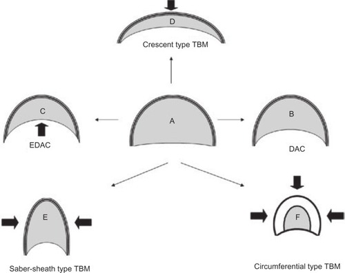 Figure 1 Airway dynamics: tracheomalacia.