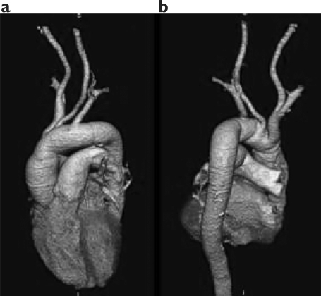Figure 5 a-b Volume Rendering (3D VR): CT-Angio after sovraortic vessels debrunching.
